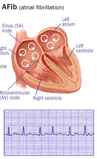 Afib