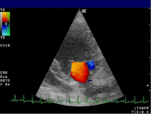 Doppler_mitral_valve