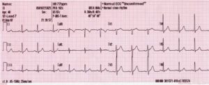 use 12_lead_generated_sinus_rhythm